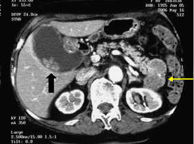 マルチスライスCT(MDCT)胆嚢癌と膵腫瘍の合併症例