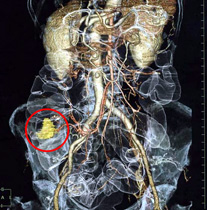 MDCTを利用したバーチャルエネマ像と支配血管像の合成大腸癌症例