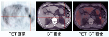 PET画像とCT画像とPET－CT画像