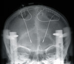 パーキンソン病に対する視床下核刺激法