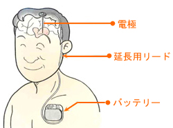 脳深部刺激法(DBS)の仕組み画像