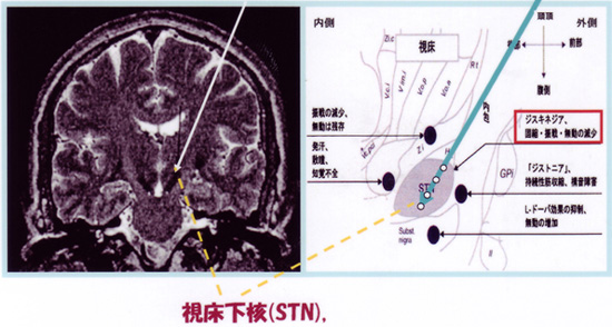 パーキンソン病に対するDBSの効果