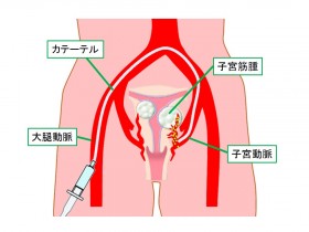 子宮動脈塞栓術